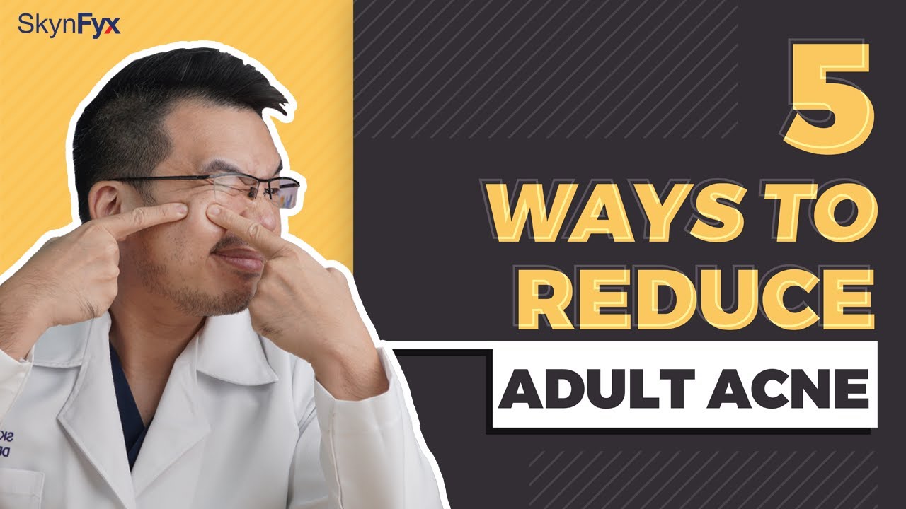 What You Need To Know About Adult Acne