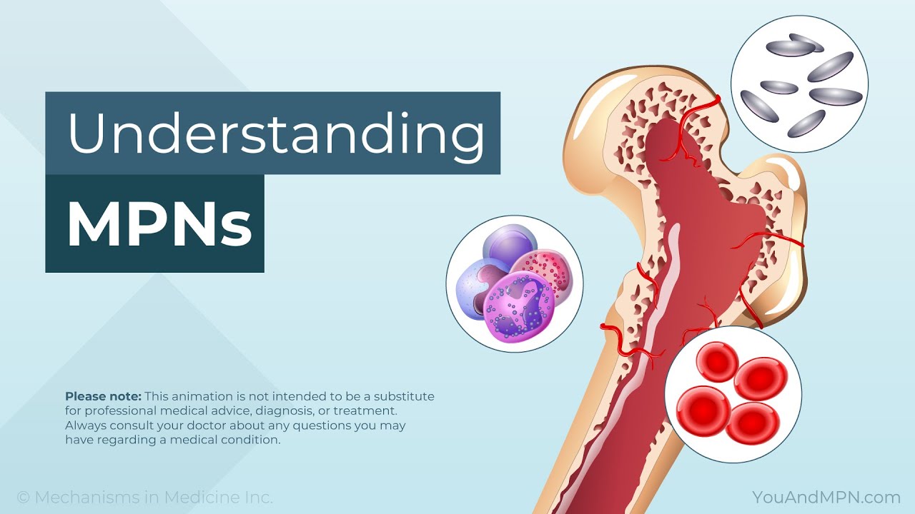 Understanding MPNs