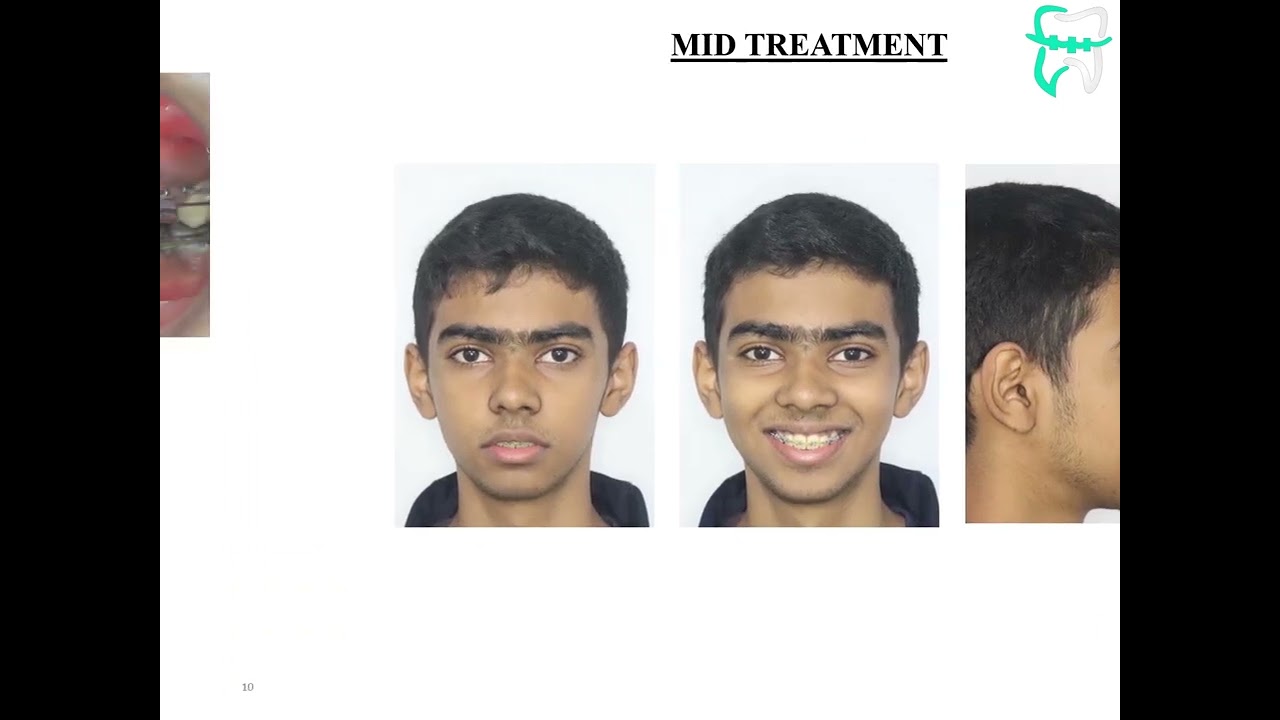 Forwardly Placed Teeth | Chinde Multispeciality Dental Clinic | Vasai west | 8999963609 | UzonMart |