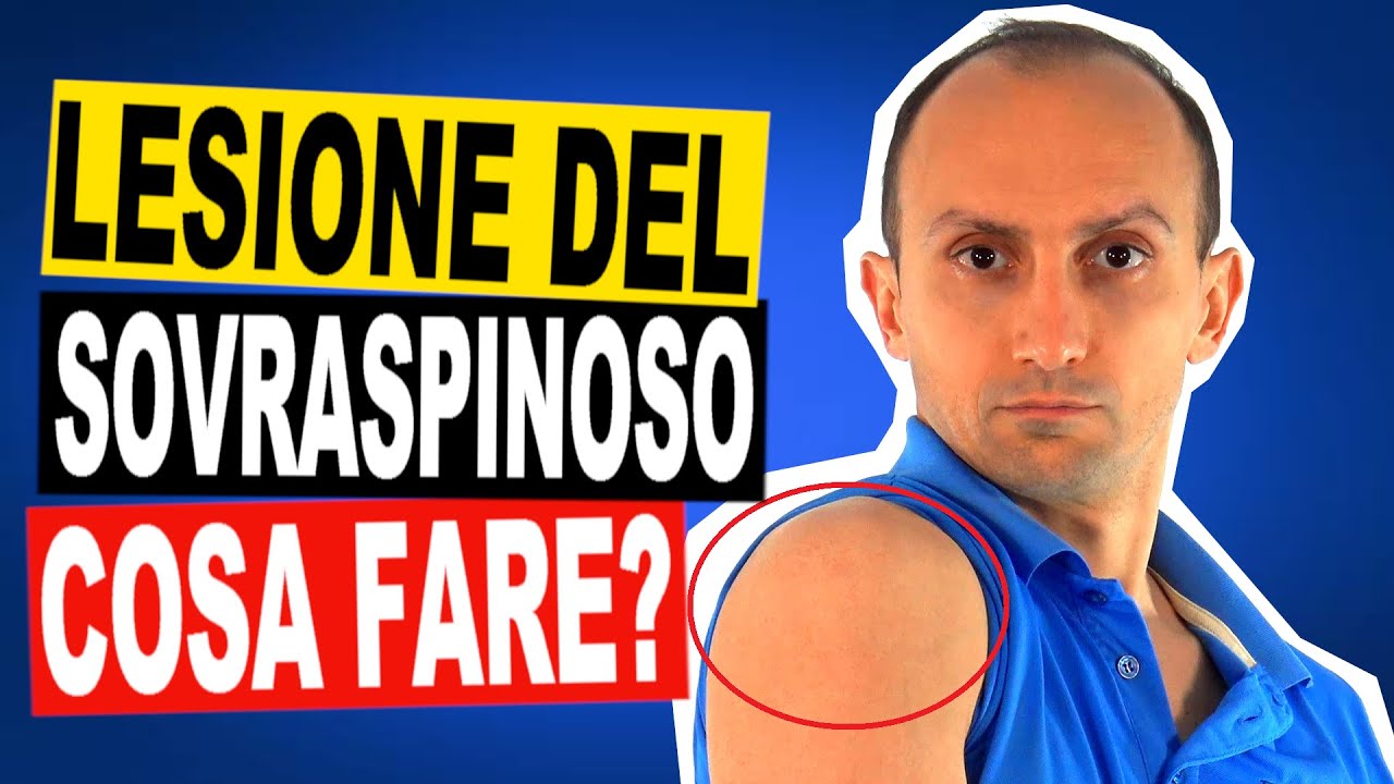 Lesione del Sovraspinoso della Spalla: la Causa e gli Esercizi di FIsioterapia