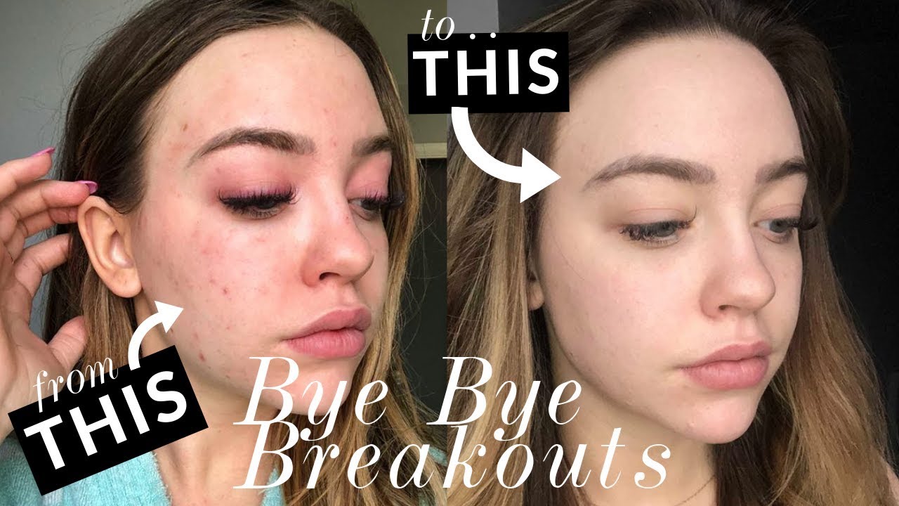 My Experience w/ Laser Genesis | ACNE & TEXTURE | Kailin Chase