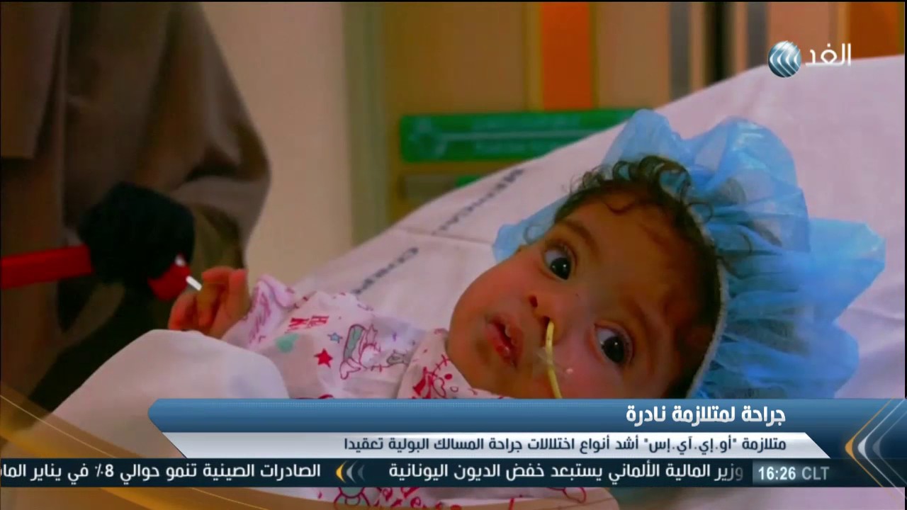 تقرير| متلازمة «أو إي آي إس» تشمل 4 عيوب خلقية وتؤدي إلى الوفاة
