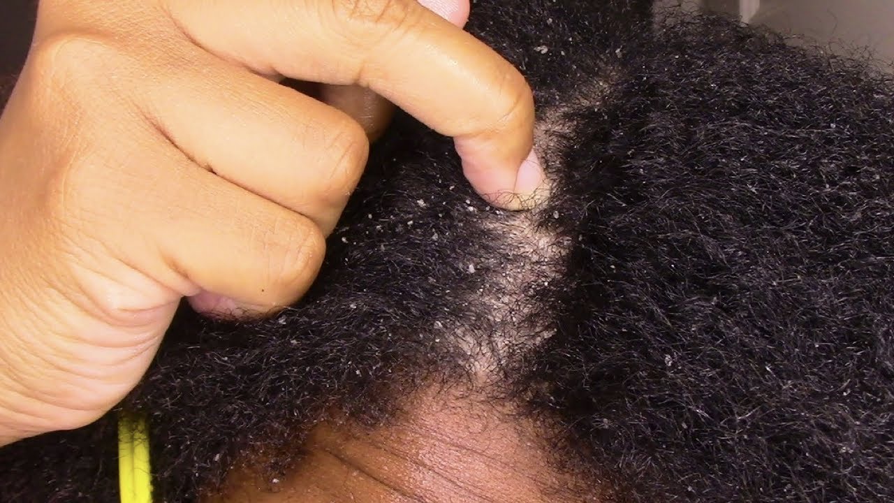 Scratching Back with Fingernails #2 #Frostedflakes #Dandruffremoval #Satisfying