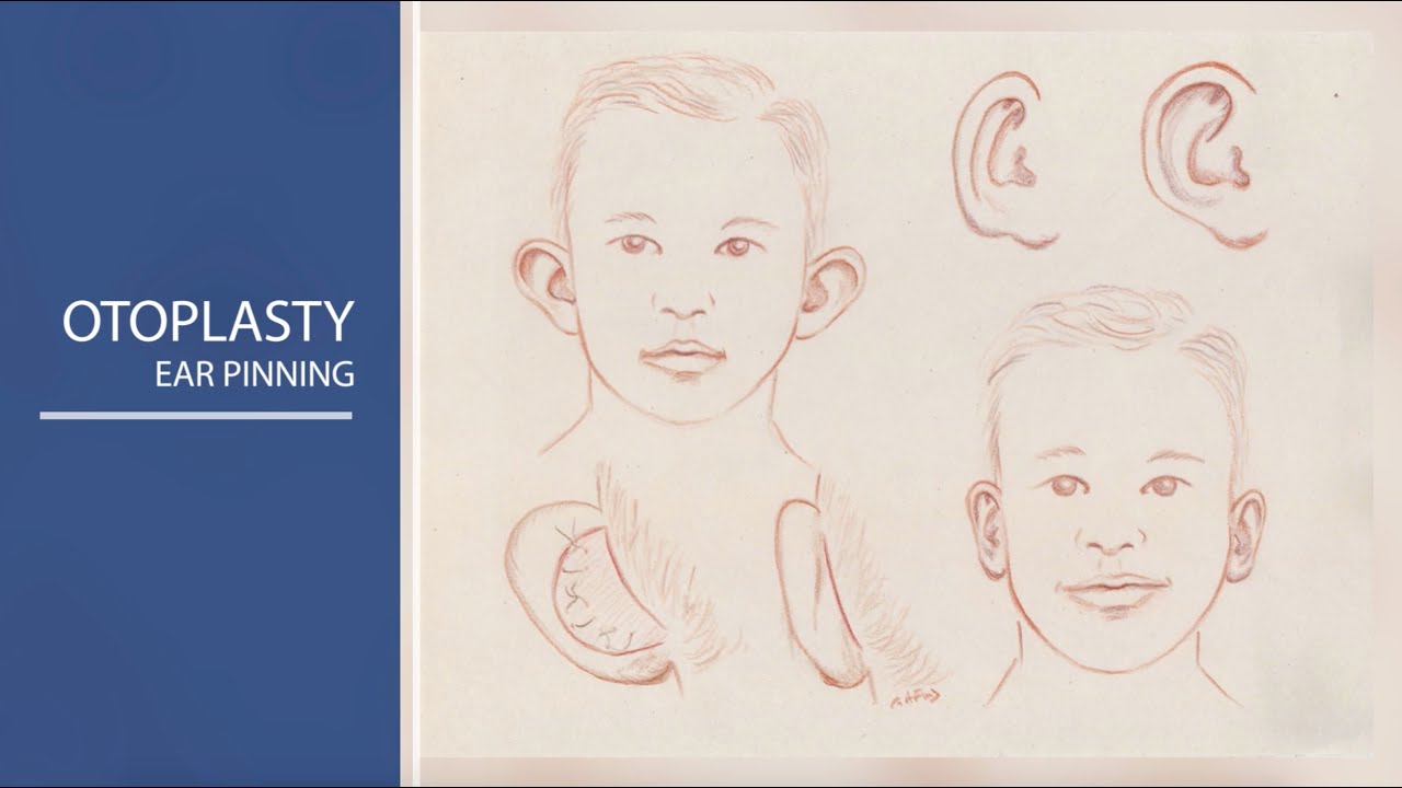 Otoplasty - Fairbanks Art of Plastic Surgery- Question 4