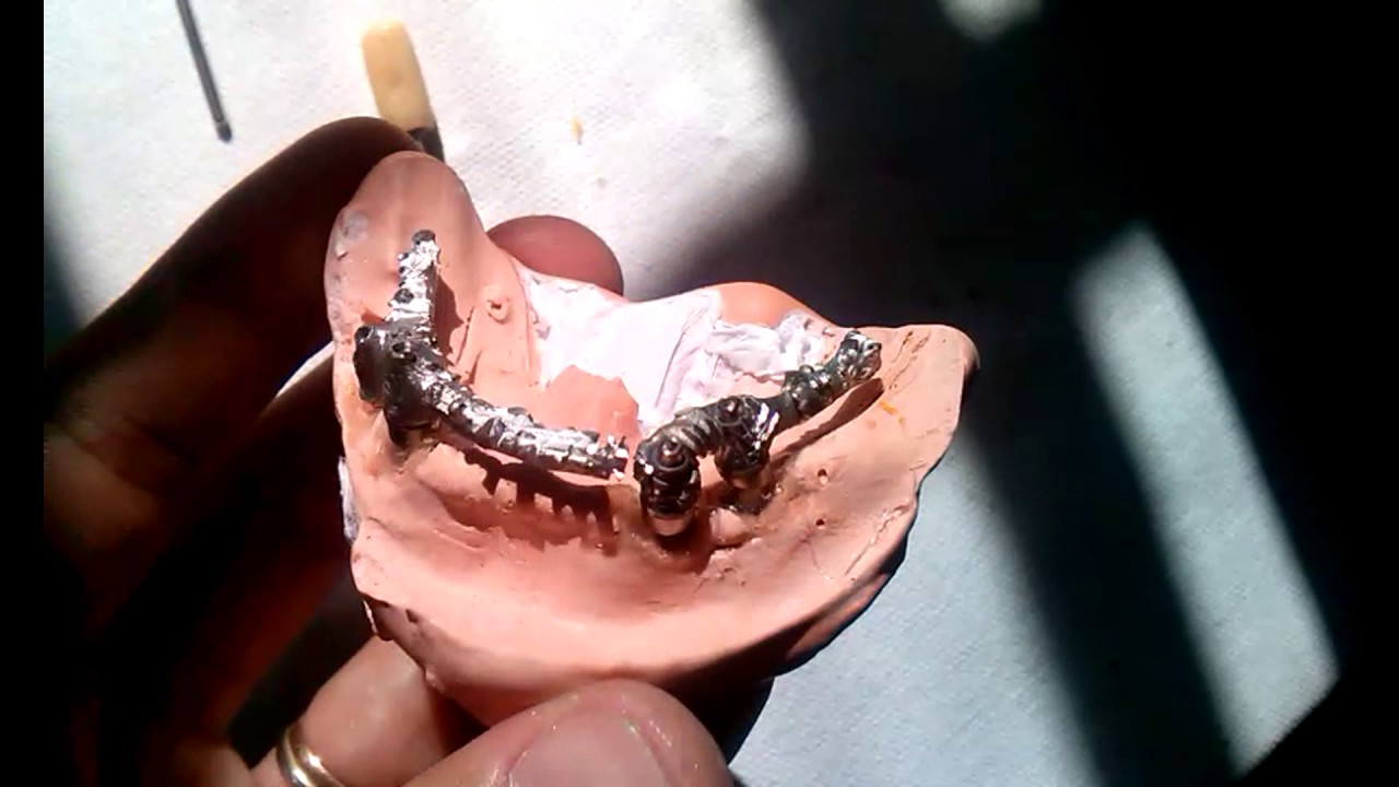 Sensacional! Sobrefundição na Protese Dental - Soldando Barra Protocolo