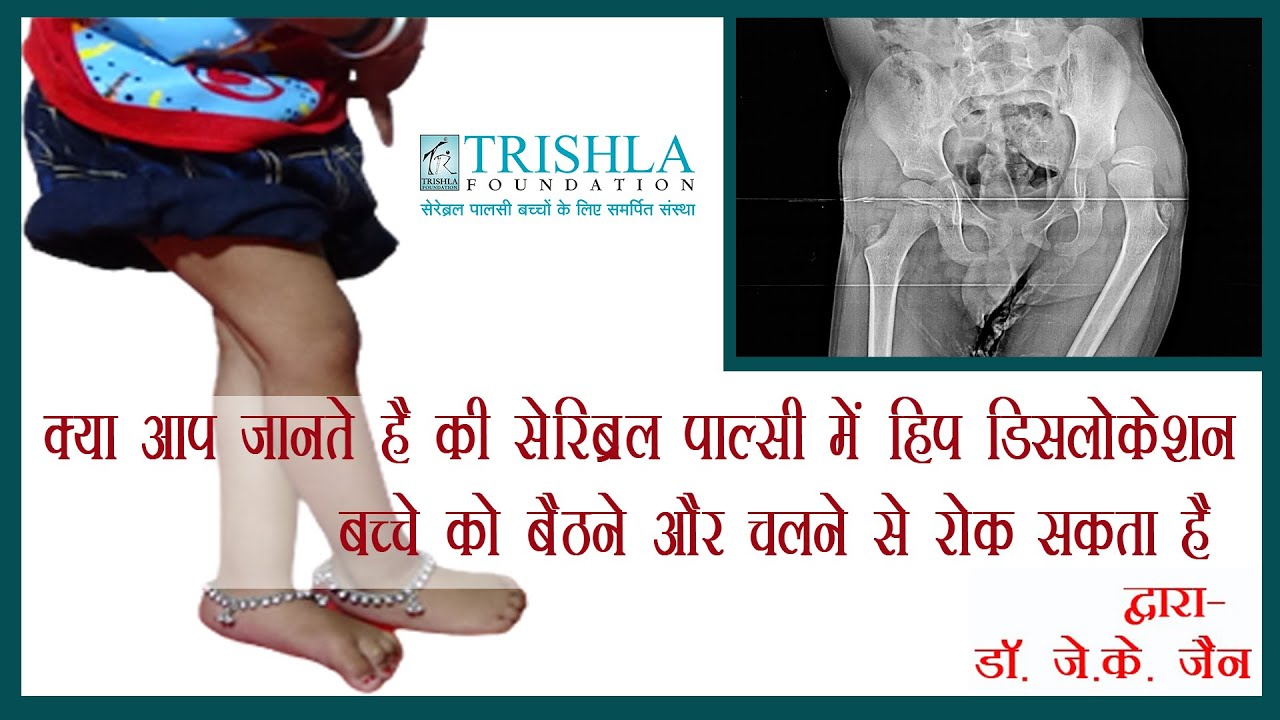 Dislocation of hip joint in cerebral palsy: causes, prevention  & treatment | Trishla Foundation