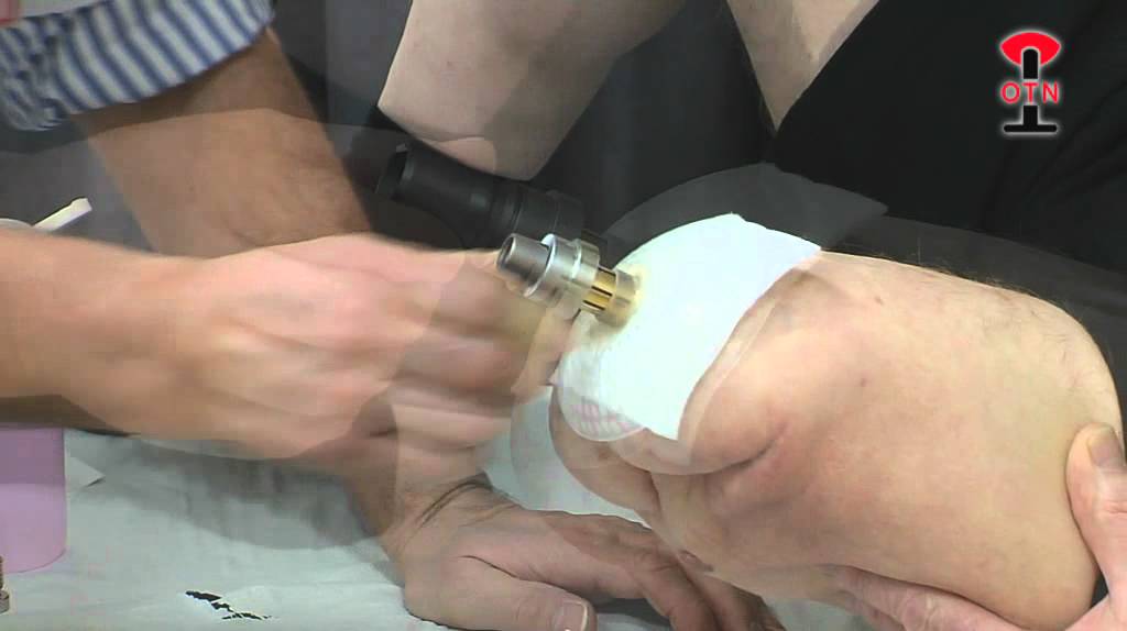 Endo Exo OTN Click Safety Adapter