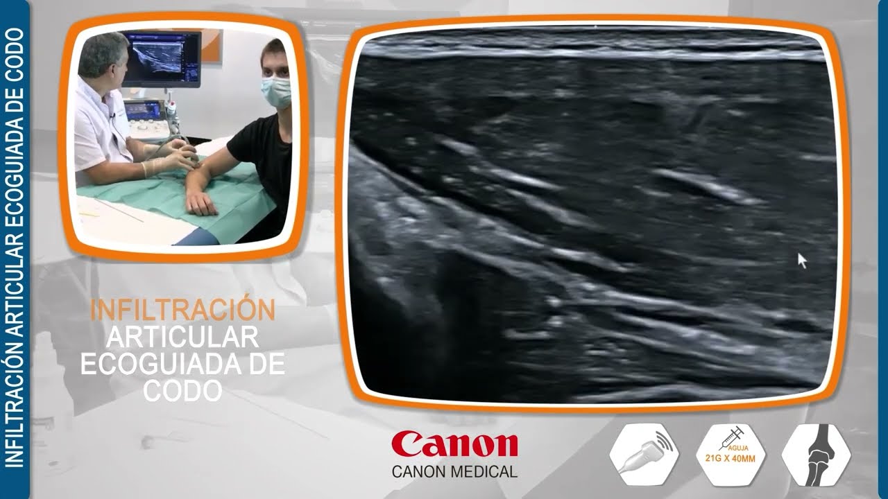 La Técnica de Infiltración Intraarticular Ecoguiada en el codo.