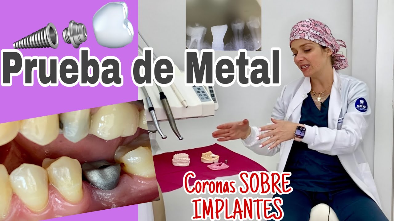 Prueba de Metal CORONAS SOBRE IMPLANTES #89