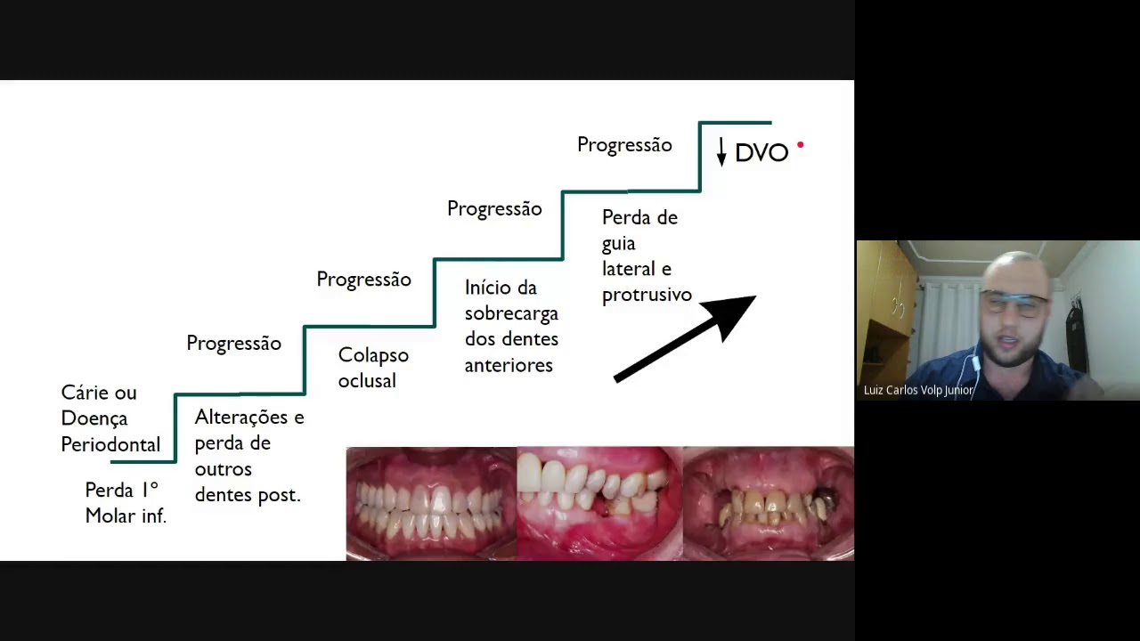 Aula de componentes prot&eacute;ticos de Pr&oacute;tese Sobre Implantes
