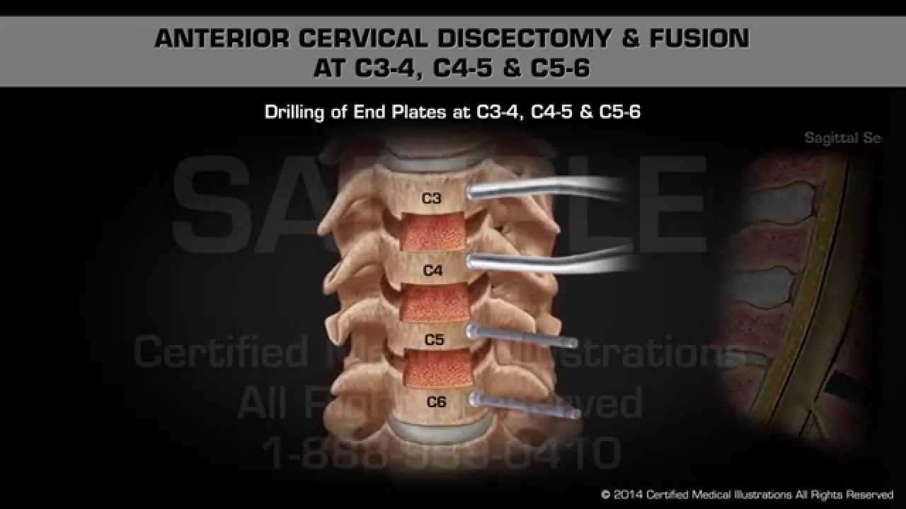 Anterior Cervical Discectomy & Fusion at C3-4, C4-5 & C5-6