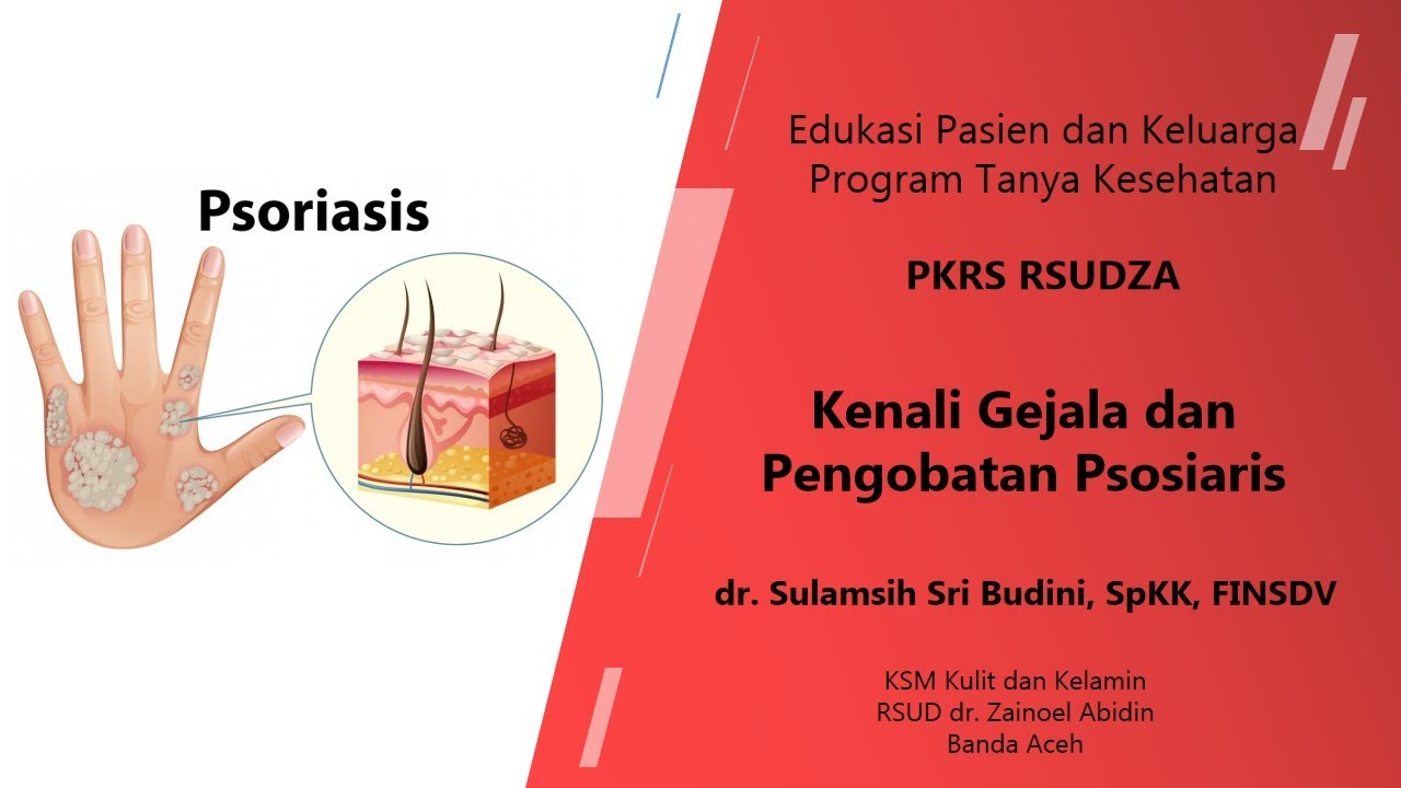 Kenali Gejala dan Pengobatan Psoriasis