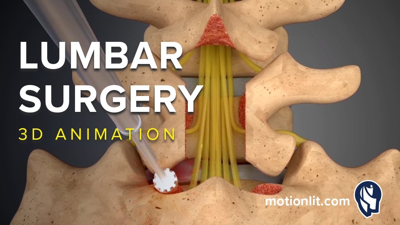 Lumbar Surgery - Laminectomy - 3D Medical Animation