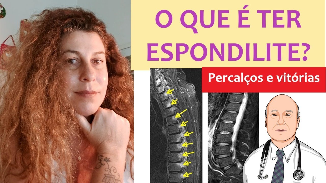 O que mudou na minha vida com a espondilite anquilosante
