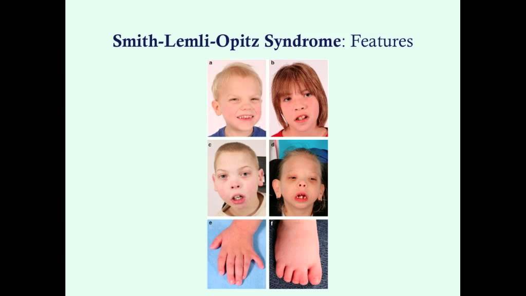 Smith-Lemli-Opitz Syndrome - CRASH! Medical Review Series