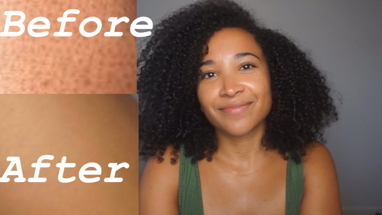How to Get Rid of Strawberry Legs For GOOD! 100% works!