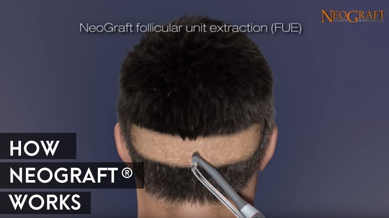 Animation on How NeoGraft&reg; Works