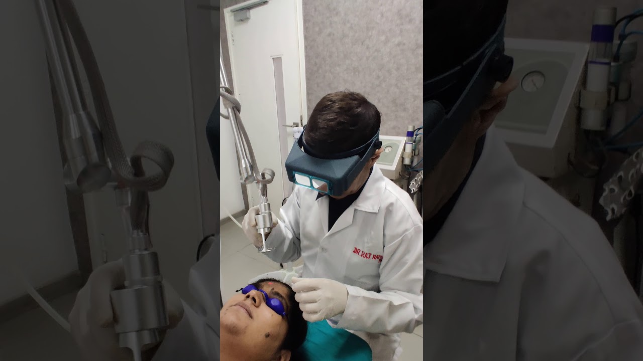 Mole Removal by CO2 Fractional Laser