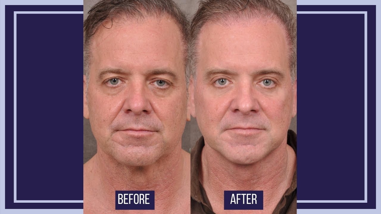 Los Angeles Male Facelift AuraLyft Testimonial | Beverly Hills Male Browlift | Dr. Ben Talei