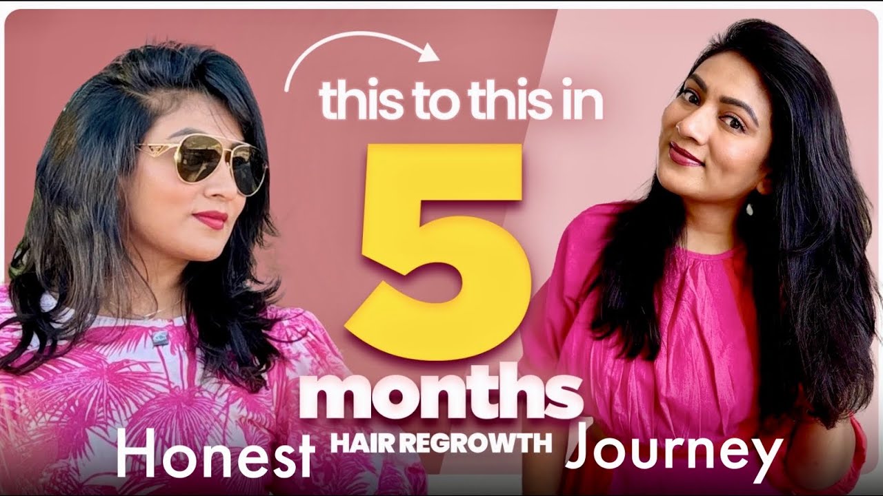 Hair regrowth in 5 MONTHS || Magic drink || Bald patch || Hairfall || Ashtrixx