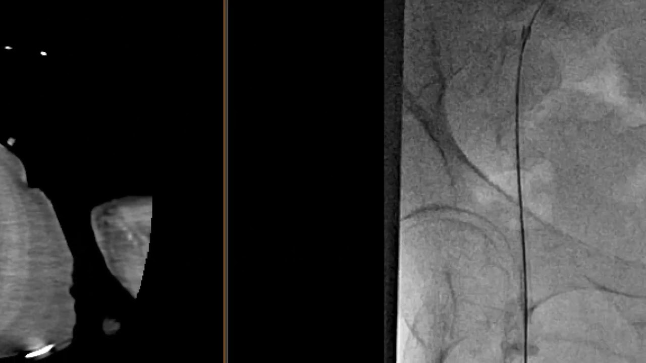 Ruptured right gastroepiploic artery aneurysm