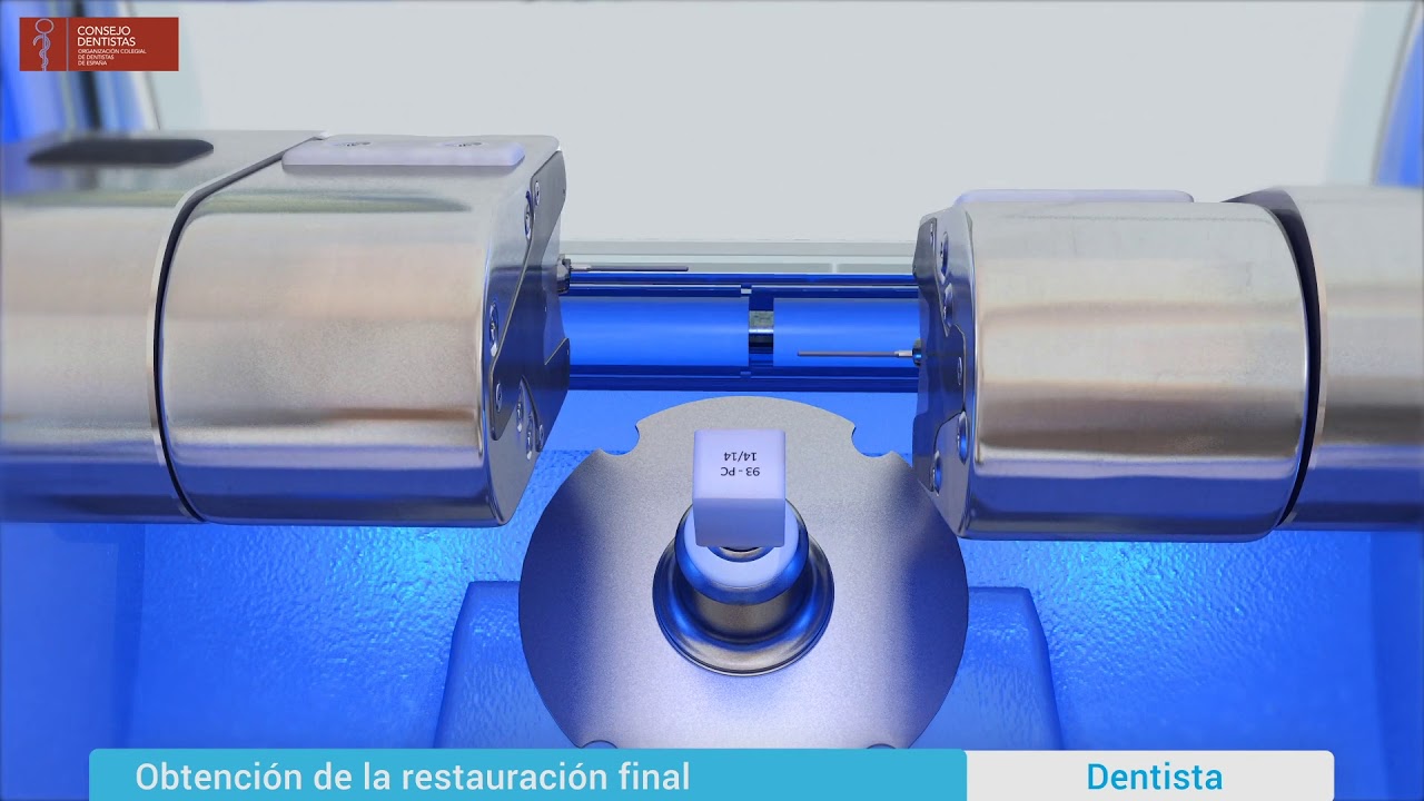 CAD/CAM Reconstrucción de diente con restauración onlay/inlay