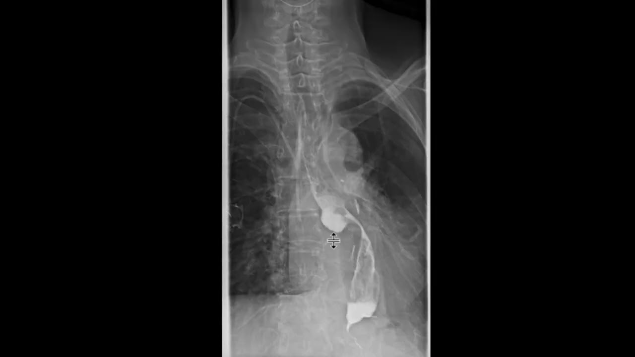 Esophageal stricture