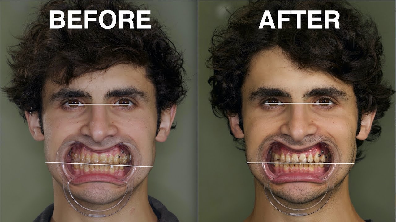 Success! Canted Smile Corrected