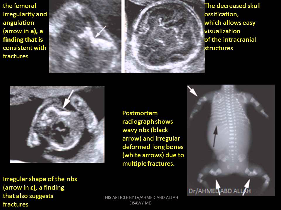 30-FETAL SKELETAL SKELETAL DYSPLASIA A Dr Ahmed Esawy
