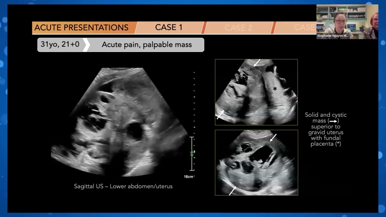 CEUS in Gyne Oncology and Pregnancy