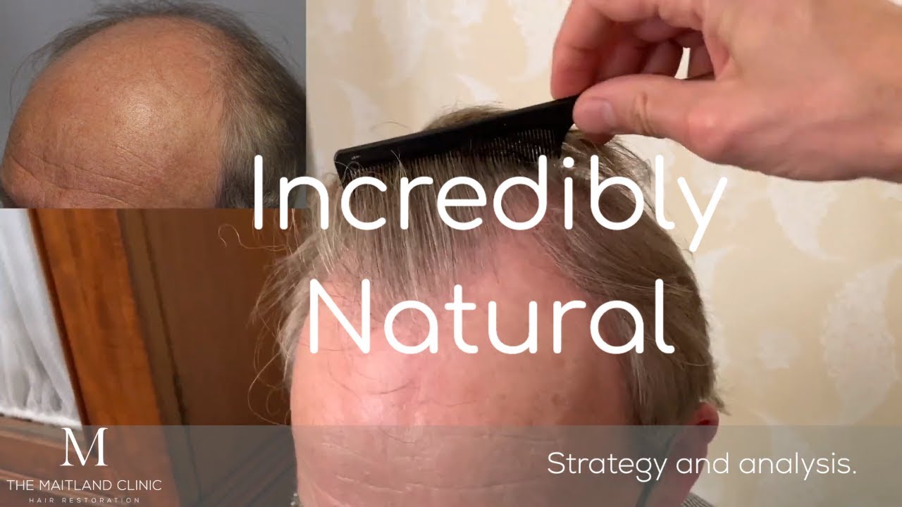 FUT Hair Transplant - 3042 Grafts by Dr. Edward Ball The Maitland Clinic