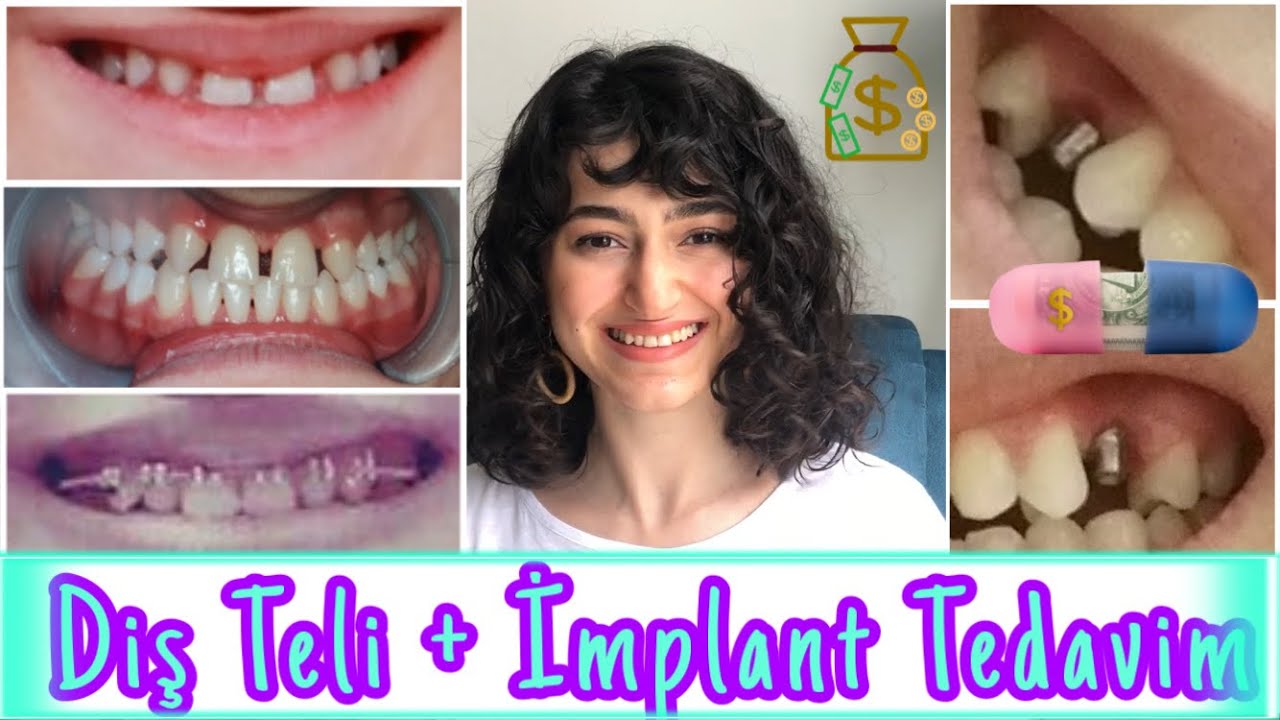 DİŞ TELİ + İMPLANT Tedavi Sürecim | Kaç PARA Ödedim?