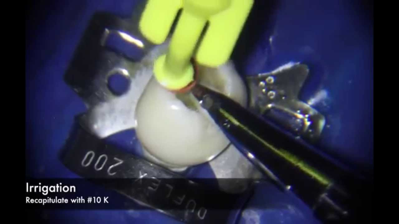 Manual Technique for Curved Root Canal Preparation