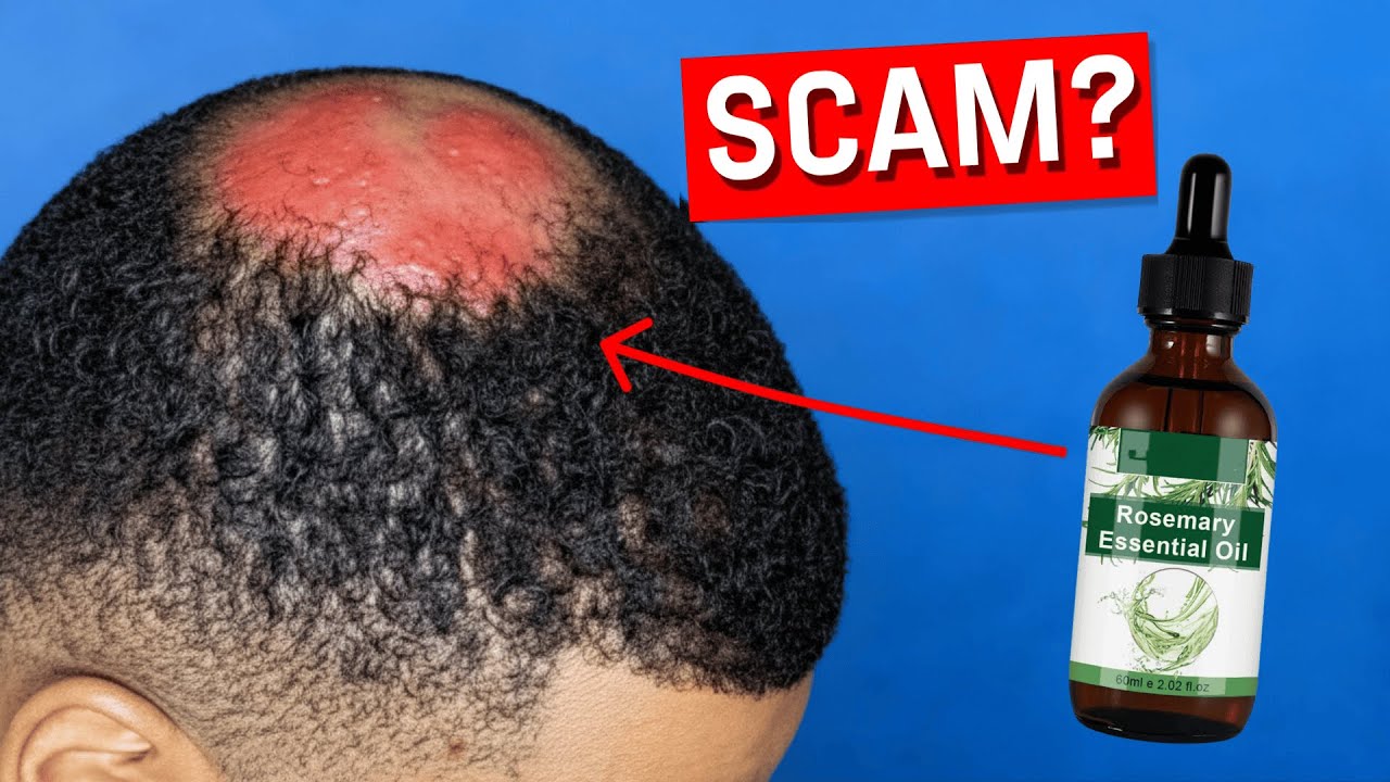 Does rosemary oil ACTUALLY work for hairloss? (Science explains)
