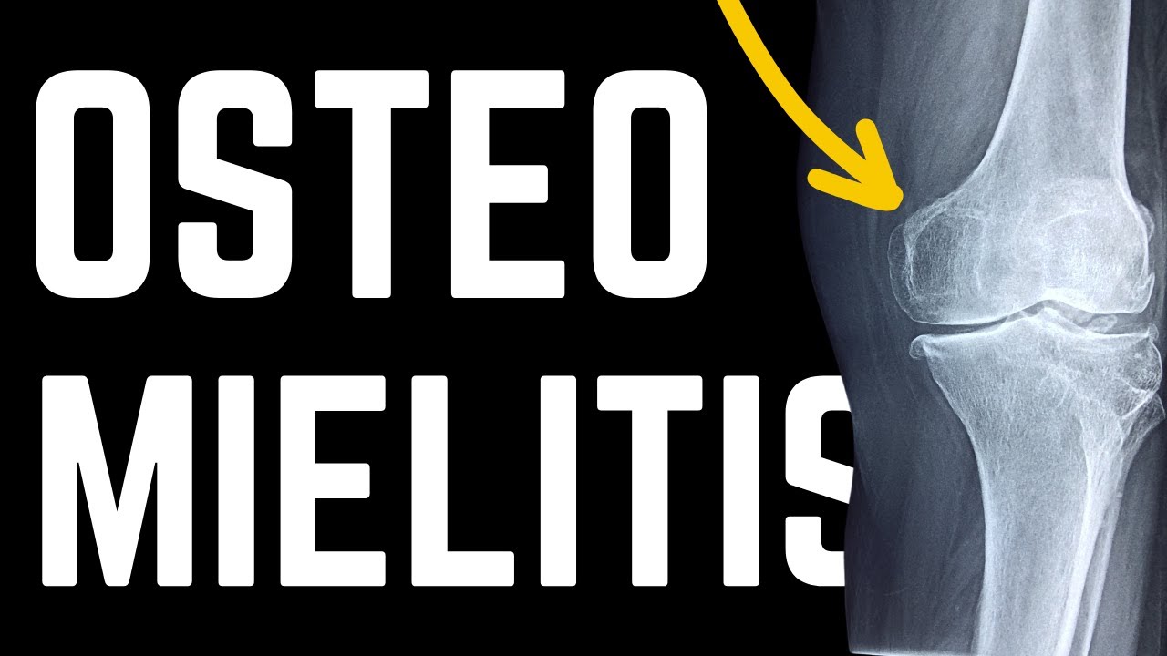 Osteomielitis Explicado Claramente