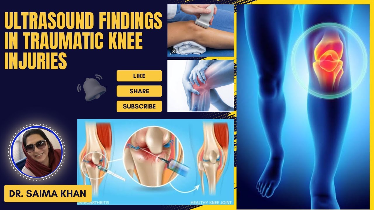 Ultrasound Findings in Traumatic Knee Injuries  #ultrasound  @Dr.Saimakhan