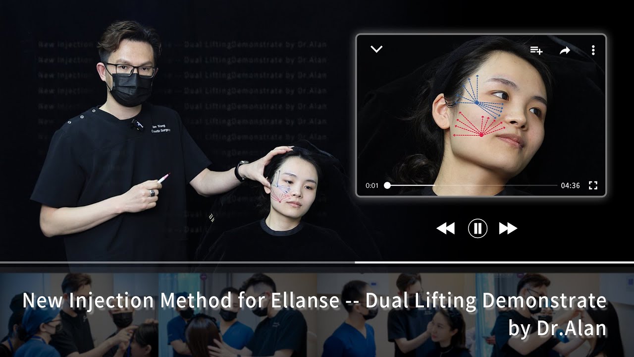 New Injection Method for Ellanse -- Dual Lifting Demonstrate by Dr.Alan