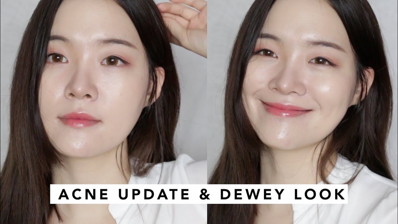 acne update + dewey foundation routine | 여드름, 피부 상태 업데이트 + 요즘 만날 하는 은은한 광채 피부 메이크업!