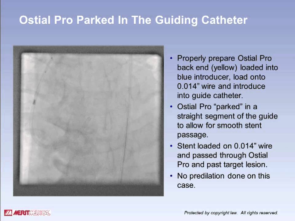 Ostial Pro&reg; Stent Positioning System Left Main #1 Case Study