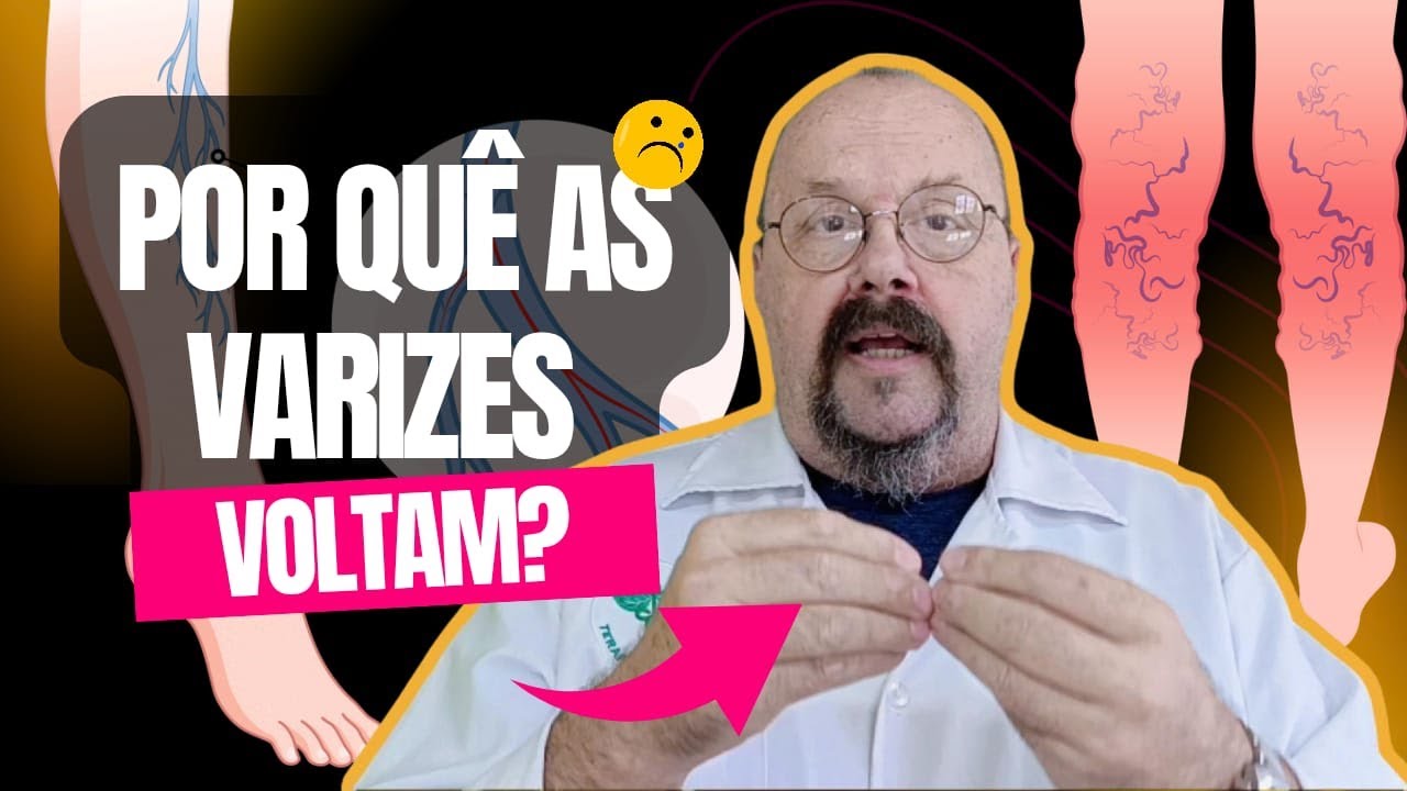 Varizes: Como Acabar com a Dor e as Varizes de vez, Melhorando a Aparência das Pernas!!!