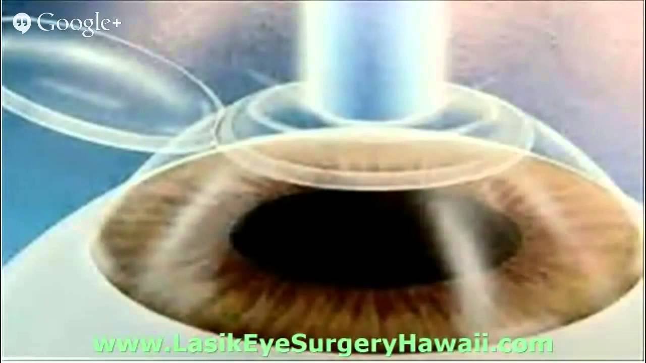 How Much Is Lasik Surgery In Hawaii 808-377-4101 Call Today