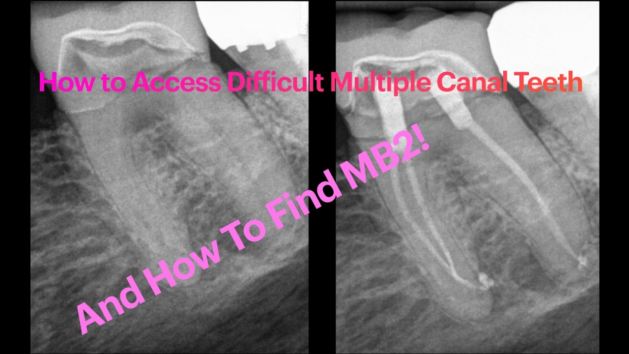 How to Access Difficult Multiple Canal Teeth AND MB2!