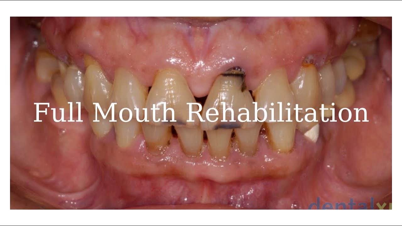 Full Mouth Rehabilitation  Clinical Overview a Systematic Approach