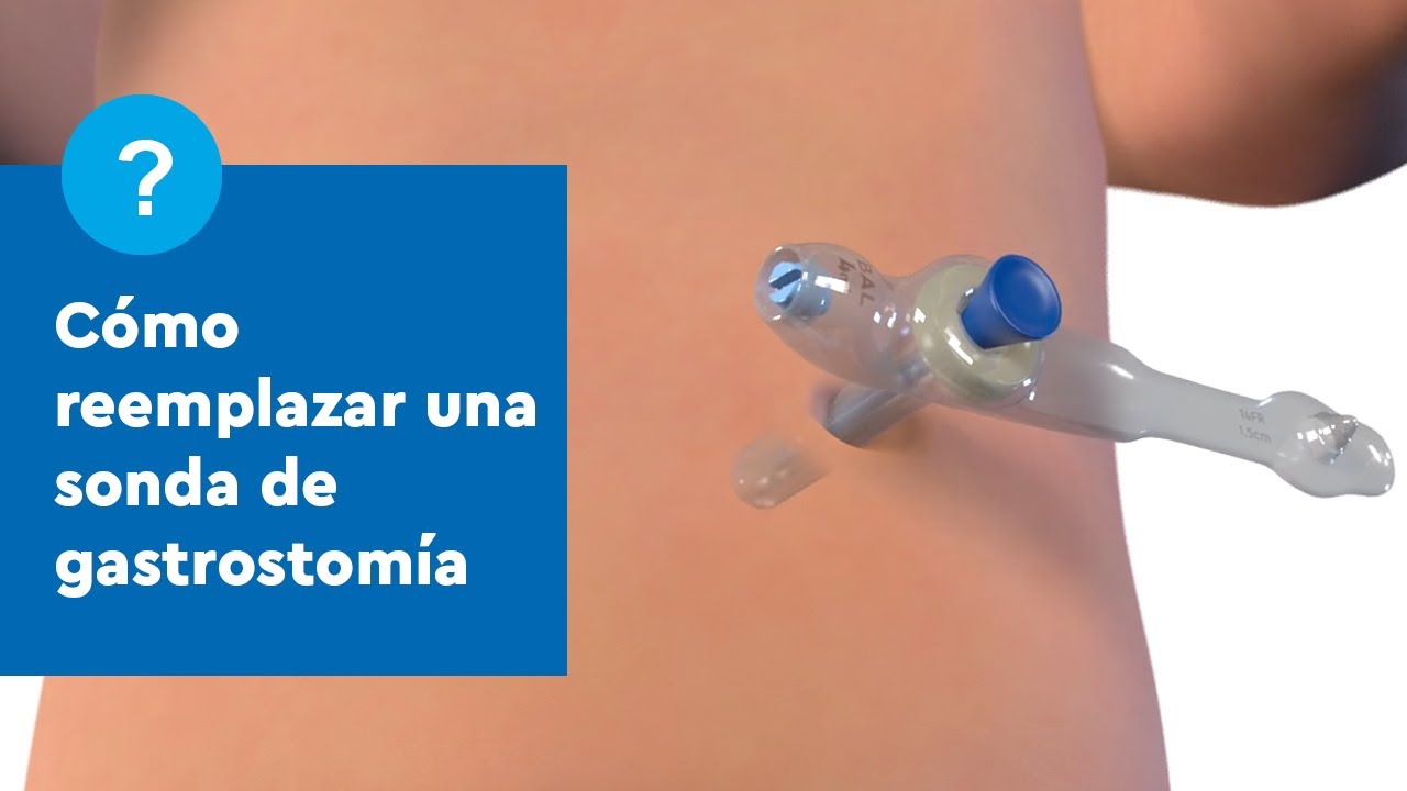Capacitaci&oacute;n sobre la sonda g&aacute;strica (Tubo G): C&oacute;mo cambiar una sonda de gastrostom&iacute;a