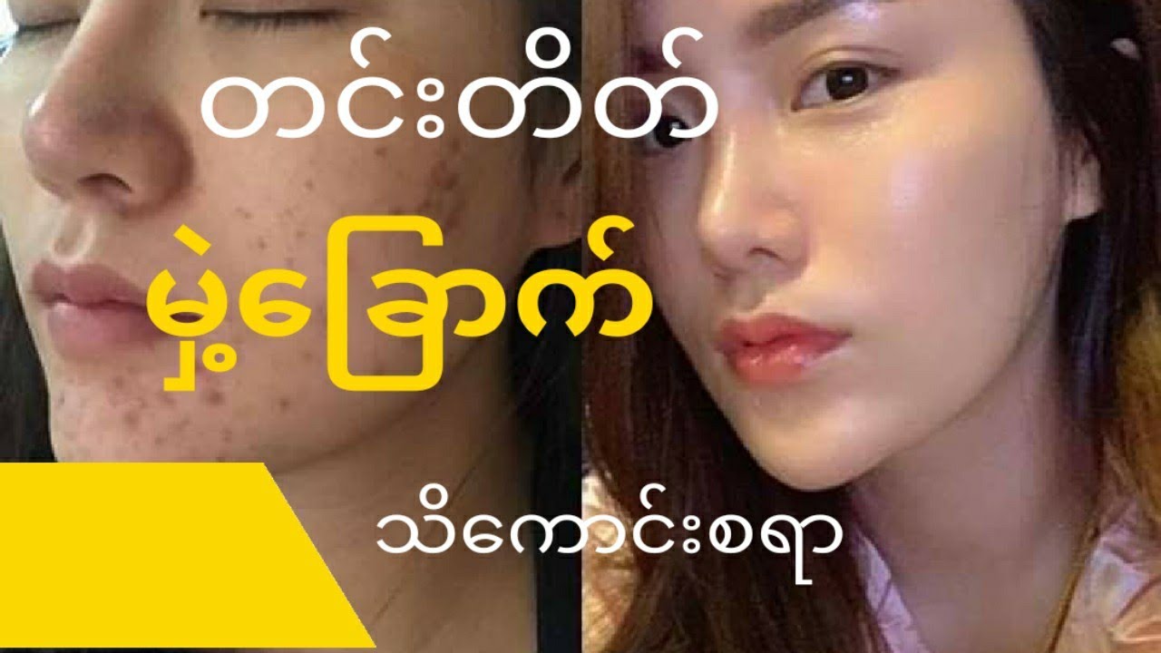 တင်းတိပ်၊မှဲ့ခြောက်အကြောင်း သိကောင်းစရာ