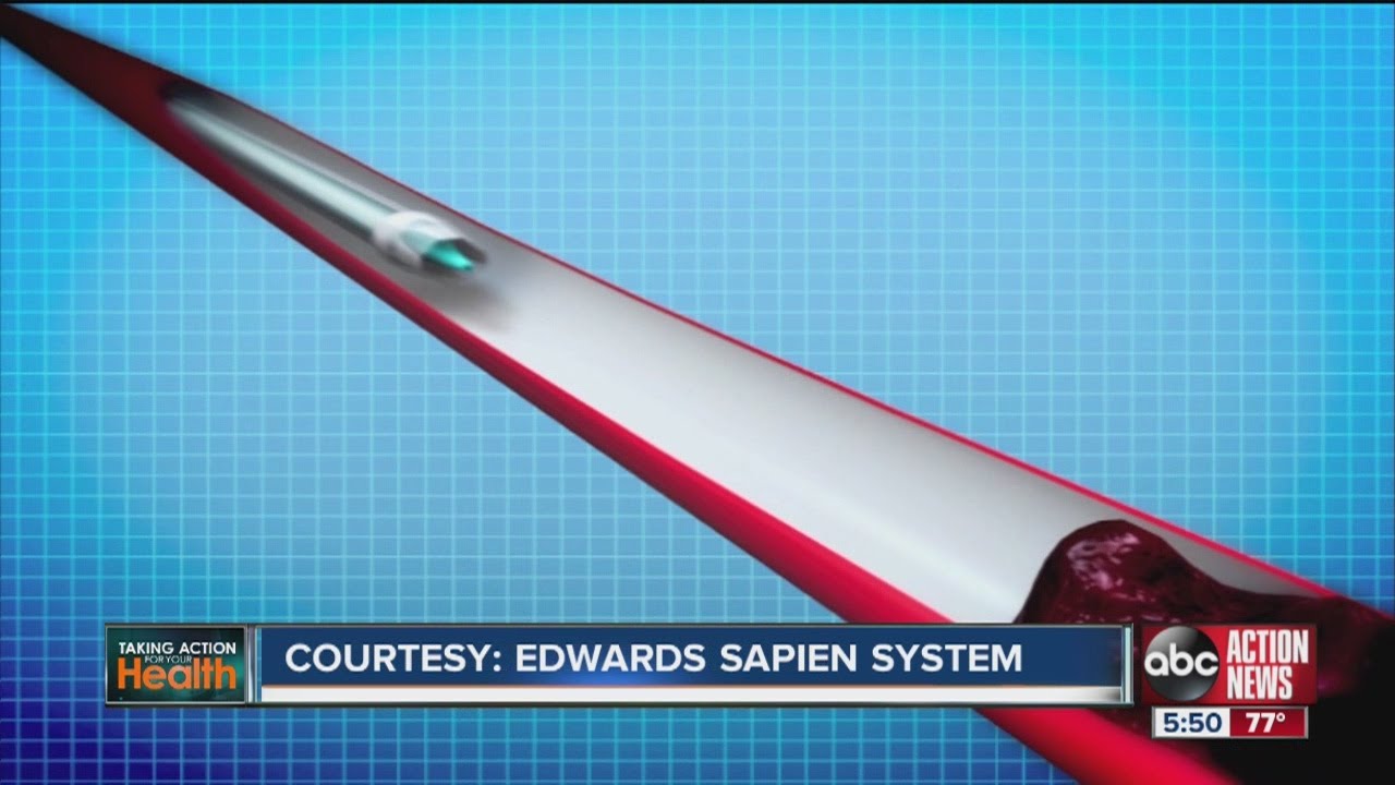 Taking Action for Your Health: Alternative to open heart surgery with no large incisions