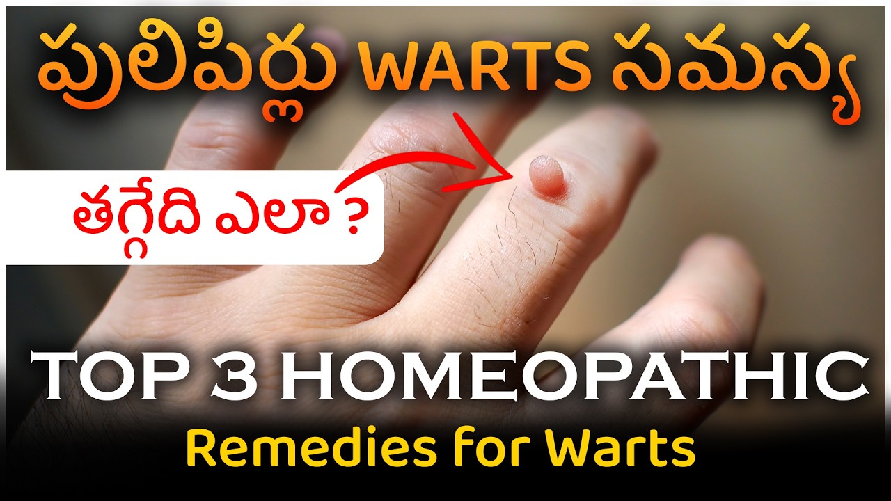 పులిపిర్లు సమస్య తగ్గేది ఎలా ? | Top 3 Homeopathic Remedies for Warts | Dr. Pavushetty Sreedhar