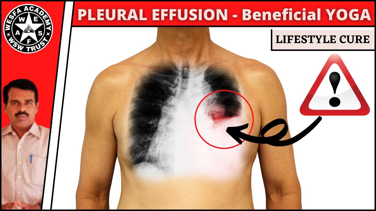 Pleural Effusion /  Beneficial yoga / Tamil / நுரையீரலில் நீர்