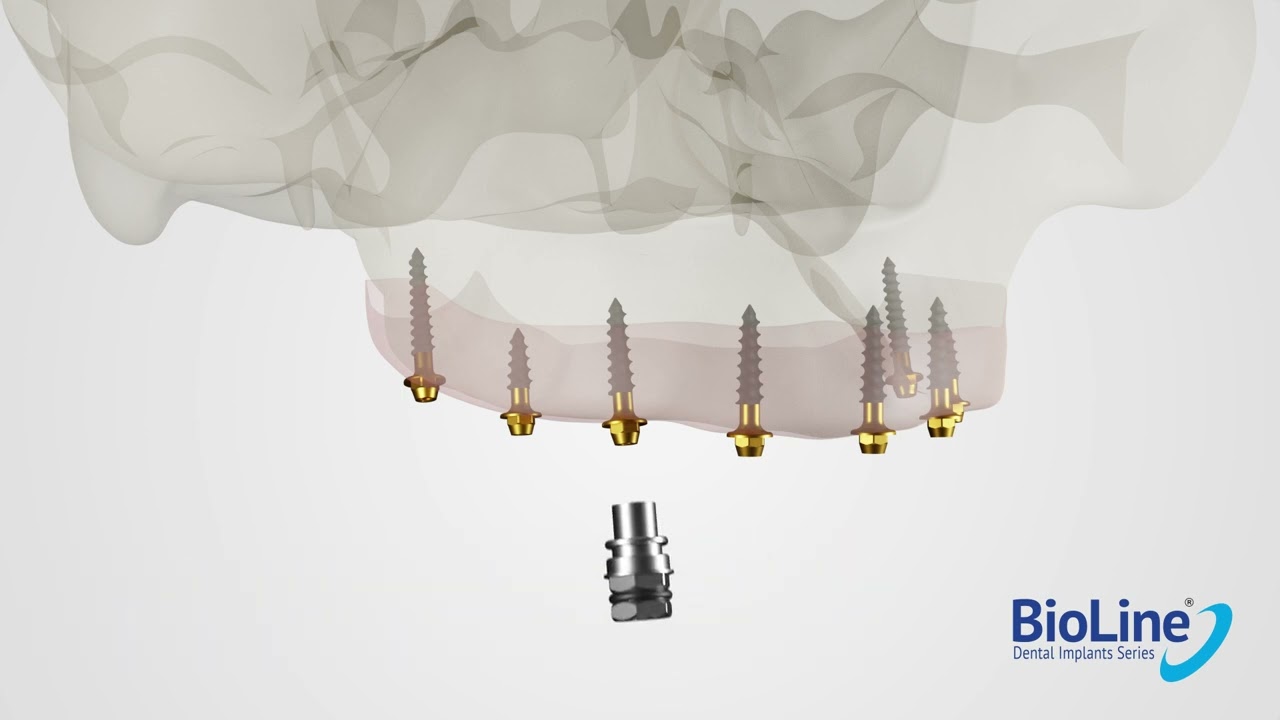 The All New BioLine Compressive Multi-Unit Implant !