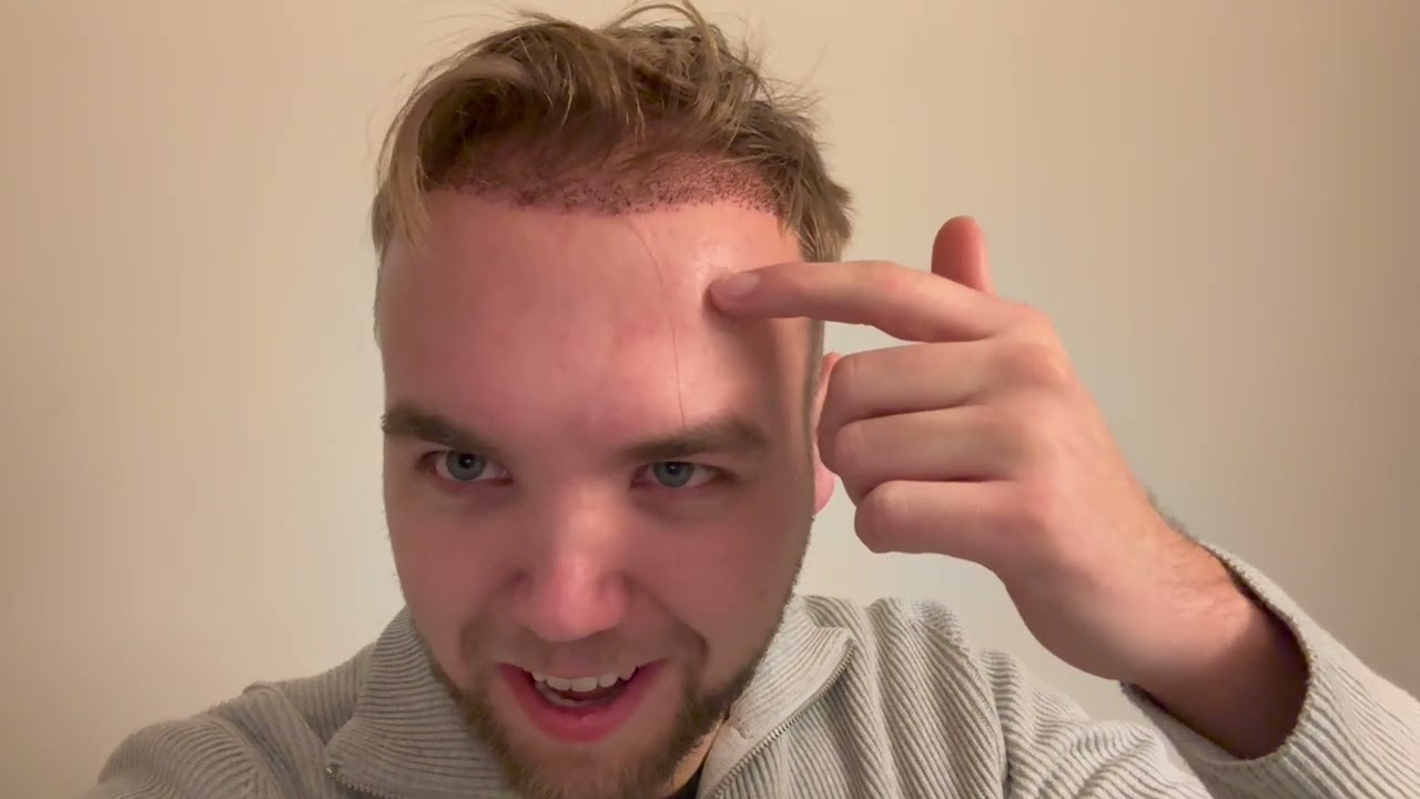 De eerste week na de haarbesparende haartransplantatie van Bas